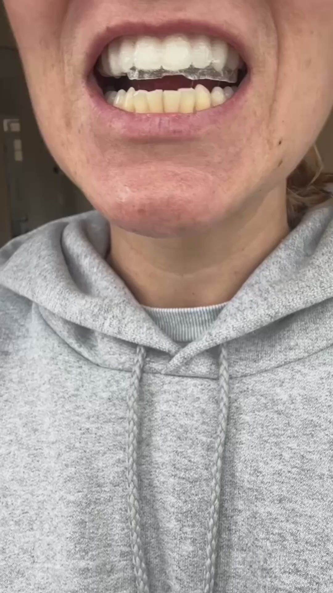 Canzara™ Teeth Whitening Strips video