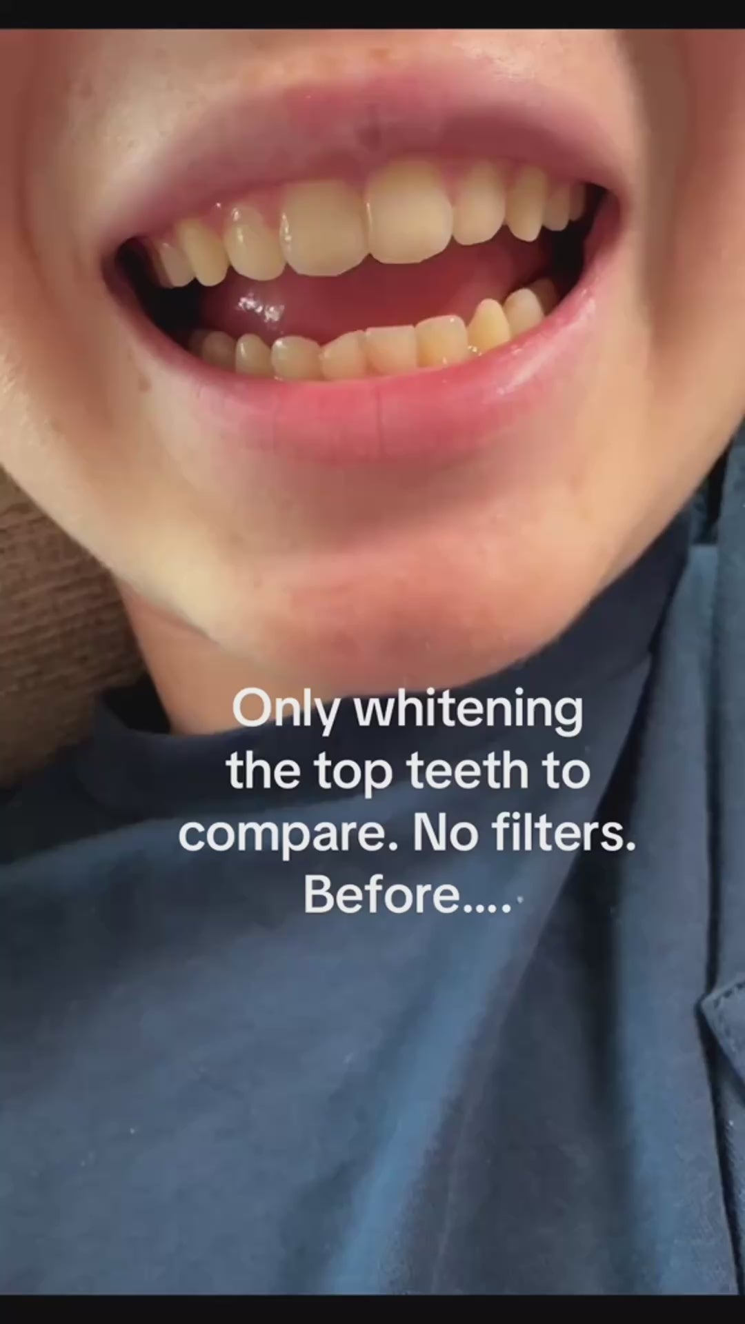 Canzara™ Teeth Whitening Strips video